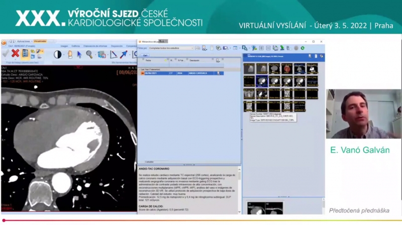video: IMPLEMENTATION OF CARDIOVASCULAR SPECTRAL DETECTOR CT SHOWN WITH CASES