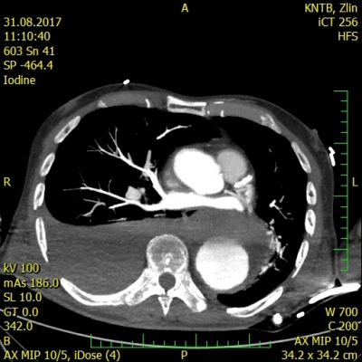 Fig. 1  Rupture of descending aorta with a right-sided hemothorax.