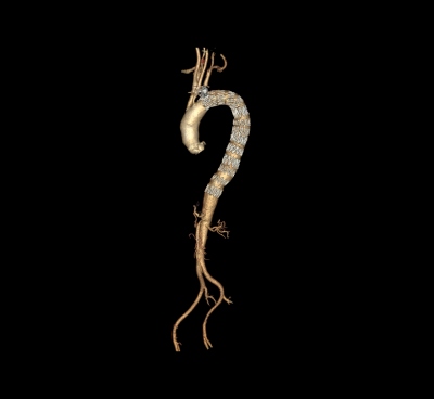 Fig. 3  Exclusion of affected part of thoracic aorta by three tubular stent grafts.