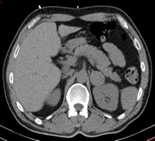 Obr. 3  Kontroln nativn CT bicha u pacienta s expanz lev nadledviny