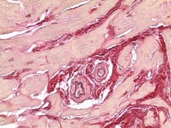 Obr. 4  Biopsie myokardu  fibrza. Barven dle van Giesona a s elastikou, zvten 400. Vazivov tk erven, kardiomyocyty lut, v centru dv arterioly.