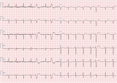 Obr. 1  EKG pacienta pi prvnm pjmu na nae pracovit. Jsou patrn negativn T v II, aVF, V5 a V6.