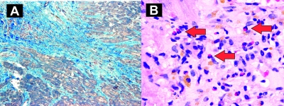 Obr. 2  Histologick vyeten vzork zskanch pi endomyokardiln biopsii. 