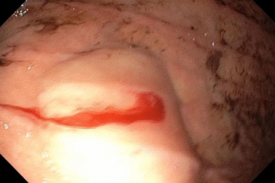 Obr. 2  Krvcen z angiodysplazie v tle aludku