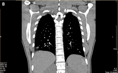 Obr. 2  (B) Koronrn projekce  CTAG: bilaterln stabiln plicn embolizace. Mnohoetn segmentrn defekty v nplni v plicn tkni bilaterln, maximln zmny v dorzobazln oblasti vpravo, kde jsou charakteru plicnho infarktu. 