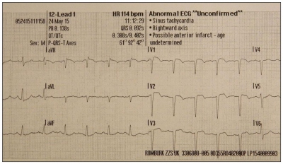 Obr. 1  12svodov EKG, elevace seku ST ve V1V4
