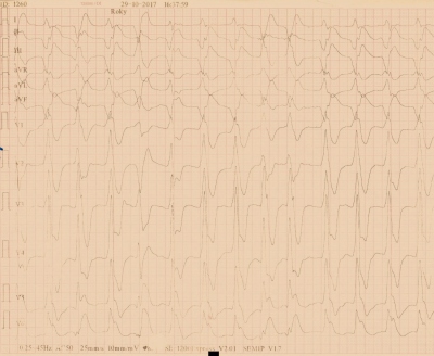 Obr. 1  Polymorfn komorov tachykardie zachycen na 12svodovm EKG v oblastn nemocnici krtce po spn kardiopulmonln resuscitaci a obnov obhu