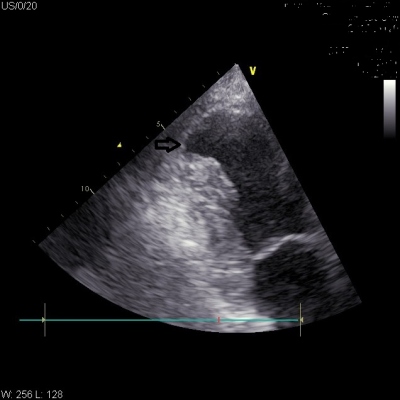 Obr. 3  Echokardiografick kontrola ped dimis: obraz lev komory srden v A2CV projekci s drobnm aneurysmatem (oznaeno ipkou) v apikln sti lev komory srden, bez znmek perikardilnho vpotku.