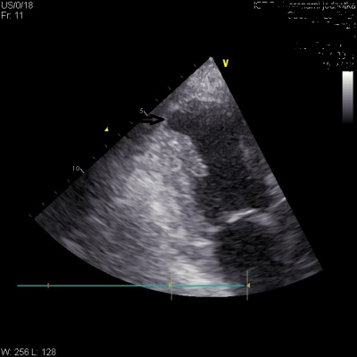 Obr. 4  Kontrola po dvou letech: obraz lev komory srden v A2CV projekci, s drobnm aneurysmatem (oznaenou ipkou) v apikln sti lev komory srden, stacionrn nlez, bez znmek perikardilnho vpotku