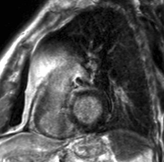 Obr. 3  Magnetick rezonance srdce, projekce na krtkou osu, LGE bazlnho anterosepta