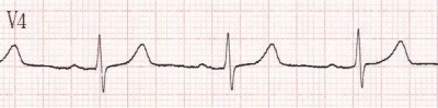 Obr. 7  EKG pi proputn