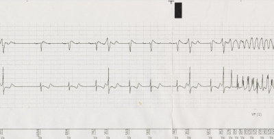 Obr. 1 – Polymorfní komorová tachykardie v paměti ICD. Horní stopa je rekonstrukcí povrchového EKG, dolní stopa intrakardiální EKG.