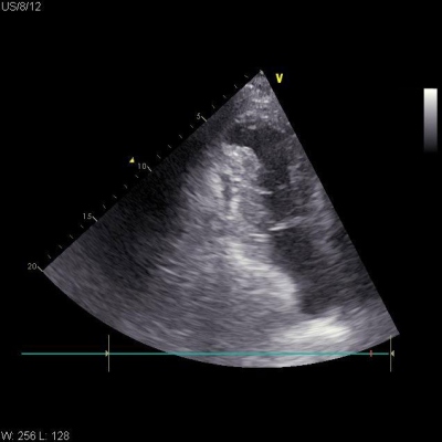 Obr. 2  (A) Echokardiografick obraz v A2CV projekci po perikardiocentze s nslednou intraperikardiln aplikac trombinu 