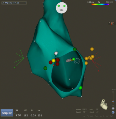 Obr. 6 – 3D anatomický model CARTO pravé srdeční síně. Žluté body označují Hisův svazek; zelené body anulus trikuspidální chlopně; žlutý bod je místo nalezení potenciálu akcesorní dráhy; červené body jsou místa úspěšné radiofrekvenční ablace.