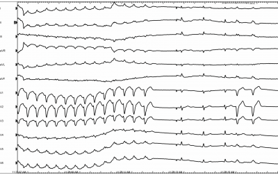 Obr. 4 – EKG v průběhu elektrofyziologického vyšetření s vyvoláním AV reentry tachykardie. V levé polovině EKG záznamu je AV reentry tachykardie; v druhé polovině EKG je stimulace síní s vlastním štíhlým komplexem QRS. Poslední dva komplexy QRS jsou rozšířené při aktivaci komor akcesorní spojkou.