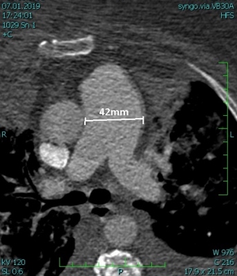 Obr.1  (A) CT angiografie s prkazem dilatace kmene plicnice, transverzln ez