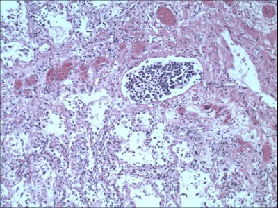 Obr. 3  Mikroskopicky patrn angioinvaze tumoru do plic