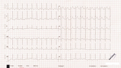 Obr. 2  Kontroln EKG se zvraznnm zmn segmentu ST ve svodech I, aVL, V5V6