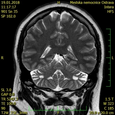 Obr. 5  Magnetick rezonance mozku s nlezem pseudocystickch defekt obou mozekovch hemisfr