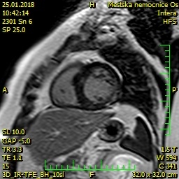 Obr. 3  Magnetick rezonance srdce  vznamn hypertrofie septa lev komory (20 mm)