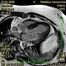 Obr. 4  Magnetick rezonance srdce  fokusy neischemick fibrzy v bazlnm segmentu anterosepta a zadn stny