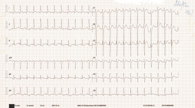 Obr. 1  EKG znmky hypertrofie LK, krtk interval PR a 1,5mm elevace segmentu ST ve svodech I, aVL 