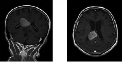 Obr. 4  Magnetick rezonance mozku prokazuje expanzivn proces v oblasti zadn sti prav postrann komory a splenium corporis callosi.