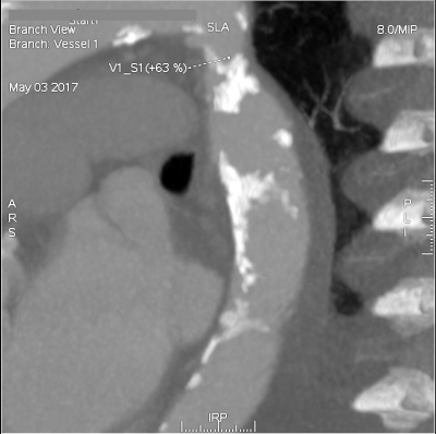 Obr. 3  (A) CT angiografie  koarktace v oblasti aortlnho isthmu