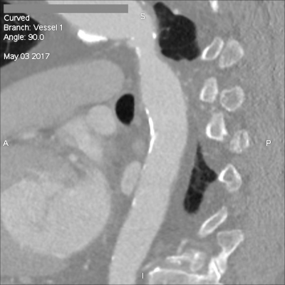 Obr. 3  (B) CT angiografie  koarktace v oblasti aortlnho isthmu