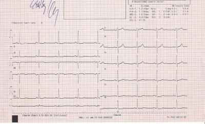 Obr. 5  EKG po obnoven sinusovho rytmu