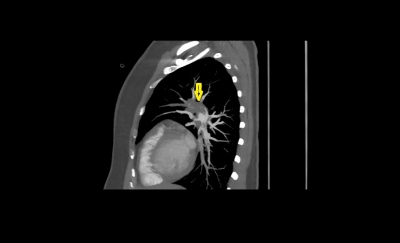 Obr. 2  CT angiografie plicnice, bilaterln plicn embolie, sagitln ez, lutou ipkou oznaen embolus
