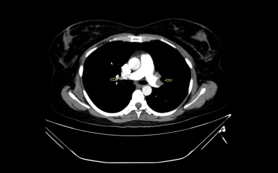Obr. 1  CT angiografie plicnice s nlezem oboustrann plicn embolie, transverzln ez, lutmi ipkami oznaeny emboly v obou vtvch arteria pulmonalis