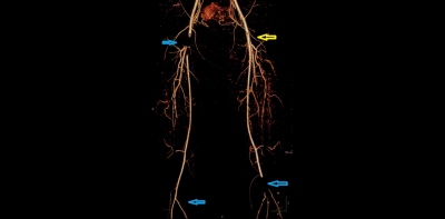 Obr. 4  CT angiografie, kontroln po podn trombolzy. Vlevo rekanalizace pnevnch tepen i arteria femoralis communis, arteria femoralis profunda i arteria superficialis (oznaeno lutou ipkou), petrvv okluze truncus tibiofibularis. Vpravo petrvv uzvr a. femoralis communis a okluze truncus tibiofibularis. (modr ipky).