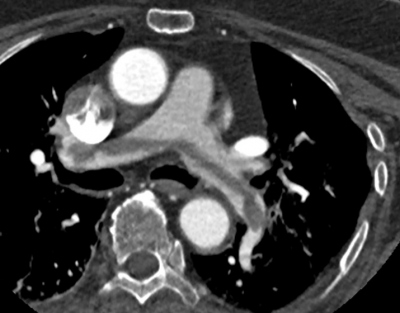 Obr. 3  CT angiografie plicnice, transverzln ez: sedlovit embolus v bifurkaci plicnice c se do obou plicnic
