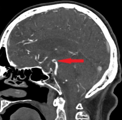 Obr. 2  CT angiografie mozkovch tepen, sagitln ez: obtkan trombus v konenm seku arteria basilaris