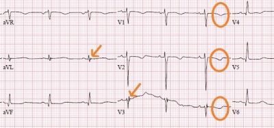 Obr. 2  Detail na EKG kivku po farmakologick kardioverzi amiodaronem  negativn T vlny ve V1V3, naznaen vlny epsilon v aVL a V3