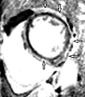 Obr. 4  Magnetick rezonance, sekvence STIR, detail na krtkou osu srdce: ipkami znzornno pozdn sycen gadoliniem (zven intenzita signlu) lev komory epikardiln prakticky difuzn