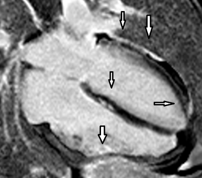 Obr. 5  Magnetick rezonance, sekvence STIR, detail na dlouhou osu srdce ve tydutinov projekci: ipkami znzornno pozdn sycen gadoliniem (zven intenzita signlu) lev komory epikardiln prakticky difuzn.