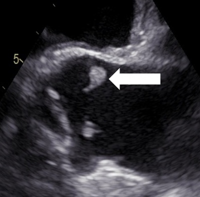 Obr. 1  Transezofageln echokardiografie, papilrn fibroelastom na okraji nekoronrnho cpu aortln chlopn u komisury s levm koronrnm cpem, podln projekce