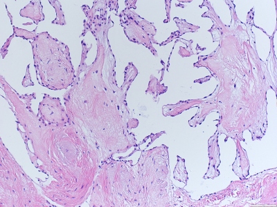 Obr. 4  Papilrn fibroelastom, histologick nlez pi barven hematoxylin-eosinem