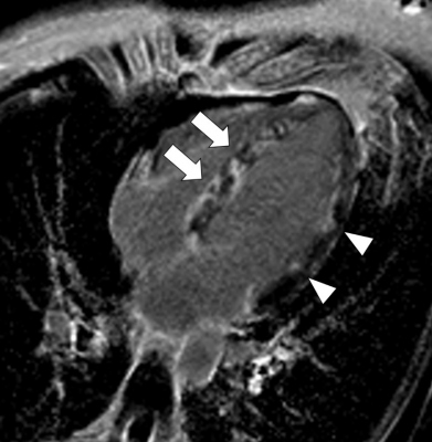 Fig. 1 Magnetic resonance imaging: T1 PSIR sequence, four-chamber view image. Non-homogenous distribution of late gadolinium enhancement with the maximum at the interventricular septum (arrows), discreetly also at the lateral wall (arrow heads).