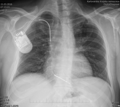 Obr. 4  Skiagram po implantaci ICD zprava. Defibrilan elektroda je umstna do hrotu prav komory.
