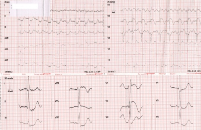 Obr. 1  EKG natoen v ZZS Moravskoslezskho kraje, vidme sinusovou tachykardii s normlnmi pevodovmi asy a obrazem elevac seku ST ve V1, V2 a depres seku ST ve svodech II, III, aVF, V4V6 (dole posun 50 mm/s, amplituda 0,5 mV).