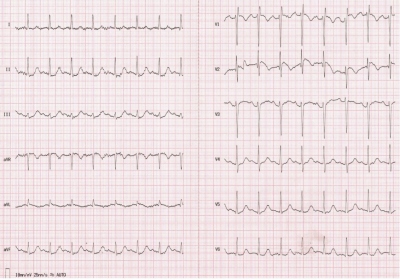Obr. 3  EKG natoen na emergentnm pjmu, trv sinusov tachykardie s poklesem elevac seku ST ve V1V2, zmrnnm depres seku ST ve II, III, aVF a V4V6.