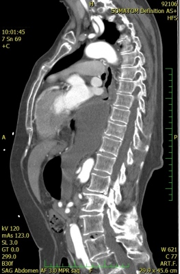 Obr. 7  CT bicha a hrudnku, stacionrn obraz pokroil smen hitovhernie charakteru upside-downstomach, vidme kontakt aludku s levou sn.