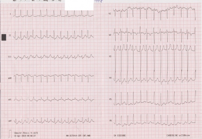 Obr. 6  EKG natoen na emergentnm pjmu s odstupem dvou dn po proputn, kde vidme fibrilaci sn s rychlou odpovd komor, deprese seku ST do 0,5 mm ve II, III, aVF.