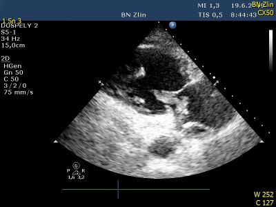 Obr. 2  Kontroln echokardiografick vyeten s optovnm prkazem vlajcho trombu v prav sni z parasternln projekce