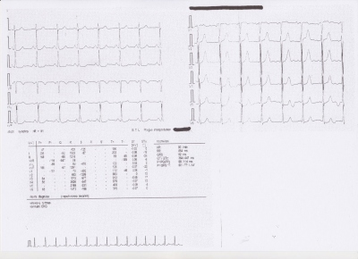 Obr. 1 – EKG křivka při vstupním vyšetření