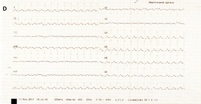 Obr. 1  (A, C) Na EKG provedenm RZS byla iniciln registrovna setrval zkokomplexov tachykardie s frekvenc 220/min s nespecifickmi zmnami ve smyslu difuznch depres seku ST a elevace v aVR. (B) Po intravenzn aplikaci 150 mg amiodaronu RZS byla na EKG zejm fibrilace sn s komorovou odpovd okolo 150/min s stupem ischemickch zmn. (D) Na naem pracoviti byla na vstupnm EKG pravideln zkokomplexov tachykardie s frekvenc 156/min.