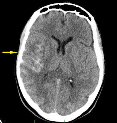 Obr. 2  CT mozku, transverzln ez, ipka znzorujc subarachnoidln krvcen temporln vpravo
